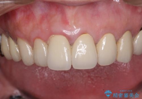 セラミック下に再発した虫歯治療の症例 治療前