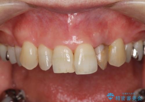 前歯の色変化　セラミッククラウンによる審美性の改善の治療前