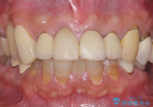多発した深い虫歯　歯周外科による歯肉改善セラミック補綴の治療前