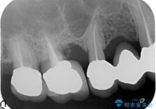 上の奥歯が保存不可能に→サイナスソケットリフトで薄い骨にも対応の治療前