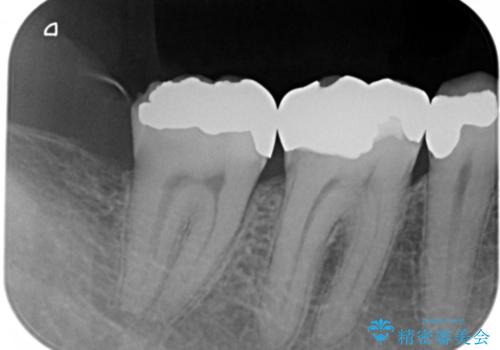 歯周外科を併用したセラミックインレー修復の治療前