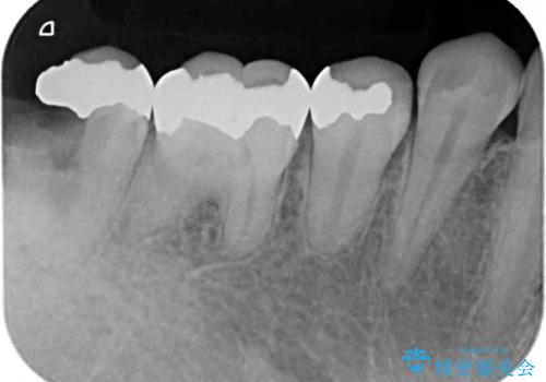 歯医者嫌いで歯がボロボロに 外科処置を用いた抜かない補綴治療の治療前