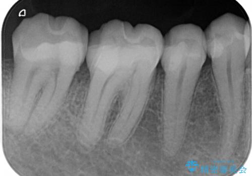歯周外科を併用したセラミックインレー修復の治療後