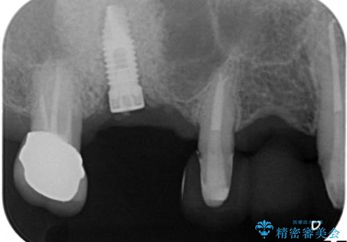 上の奥歯が保存不可能に→サイナスソケットリフトで薄い骨にも対応の治療中