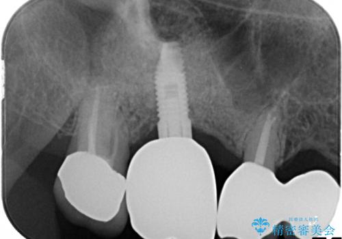 上の奥歯が保存不可能に→サイナスソケットリフトで薄い骨にも対応の治療後