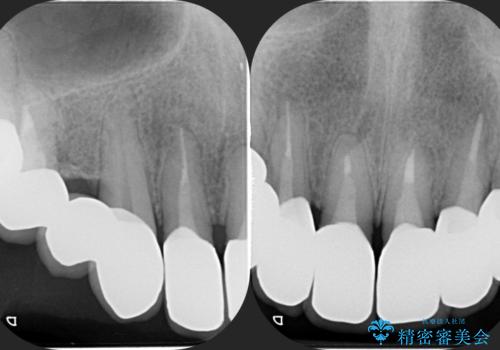 多発した深い虫歯　歯周外科による歯肉改善セラミック補綴の治療後