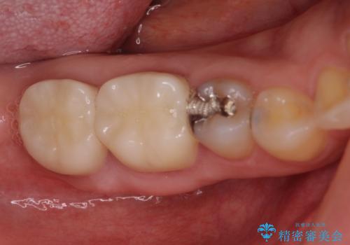 歯医者嫌いで歯がボロボロに 外科処置を用いた抜かない補綴治療の治療後