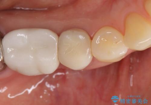 オールセラミッククラウン　歯茎との隙間が気になる被せ物の修復の治療前