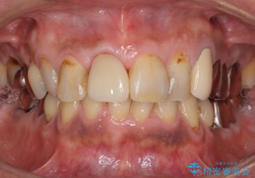 前歯がとれた　残った小さい歯を引っ張り出して保存するの症例 治療後