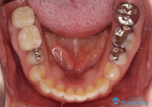 歯医者嫌いで歯がボロボロに 外科処置を用いた抜かない補綴治療の治療後