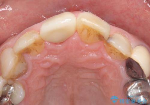 前歯がとれた　残った小さい歯を引っ張り出して保存するの治療後