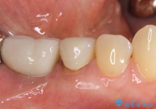 オールセラミッククラウン　歯茎との隙間が気になる被せ物の修復の治療前
