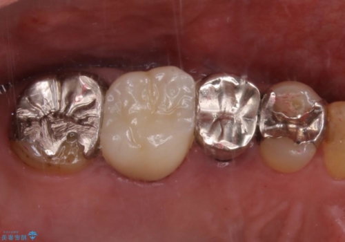 根管治療からやり直し　奥歯の被せ物までの治療後
