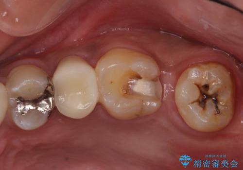 左上奥歯の虫歯　白い詰め物セラミックインレーの治療中