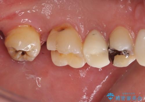 左上奥歯の虫歯　白い詰め物セラミックインレーの治療中