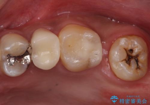 左上奥歯の虫歯　白い詰め物セラミックインレー