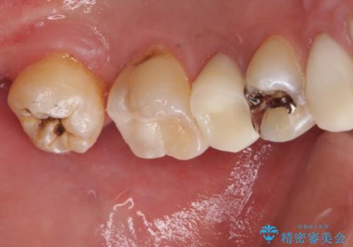 左上奥歯の虫歯　白い詰め物セラミックインレーの治療後