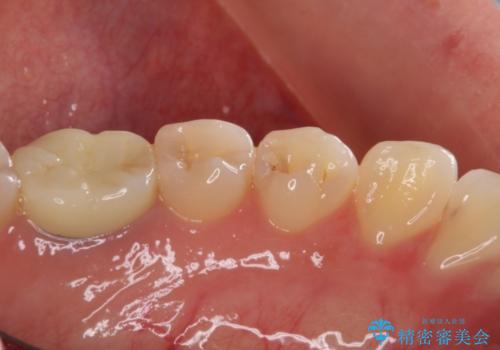 セラミックインレーによる早期発見の虫歯治療の治療前