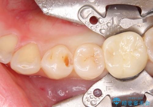 セラミックインレーによる早期発見の虫歯治療