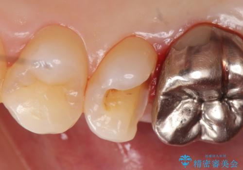 セラミックインレー　被せ物が取れた歯の治療の治療中