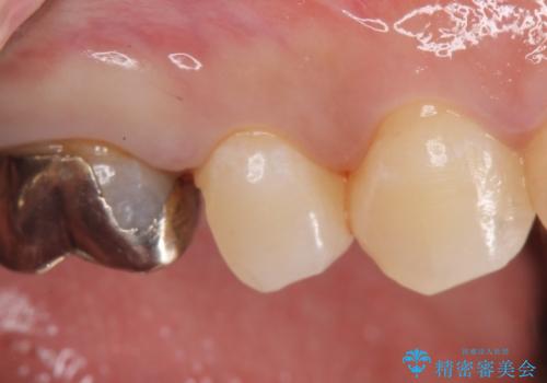 セラミックインレー　被せ物が取れた歯の治療の治療中