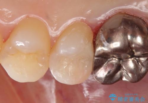 セラミックインレー　被せ物が取れた歯の治療の治療後