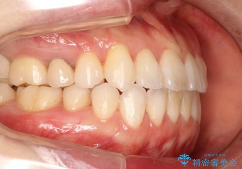 歯を抜かずに八重歯をきれいに!　インビザラインによる全顎矯正治療の治療後
