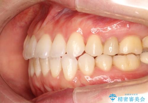 歯を抜かずに八重歯をきれいに!　インビザラインによる全顎矯正治療の治療後