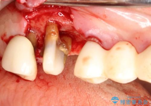 上の奥歯が保存不可能に→サイナスソケットリフトで薄い骨にも対応の治療前
