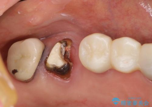 上の奥歯が保存不可能に→サイナスソケットリフトで薄い骨にも対応の症例 治療前