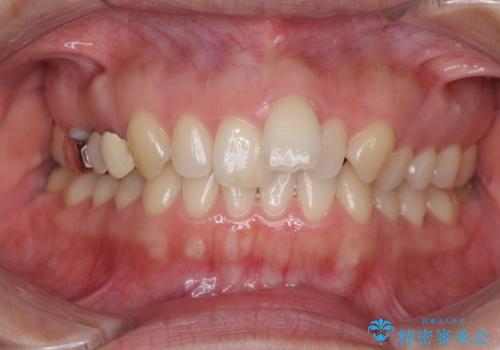 上の前歯の出っ歯を抜歯矯正で改善の症例 治療前