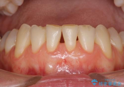 前歯の歯肉退縮　歯肉移植による根面被覆の症例 治療後