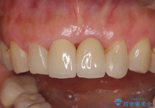 歯茎の腫れた前歯を綺麗にしたい　部分矯正を用いたセラミック治療の症例 治療後