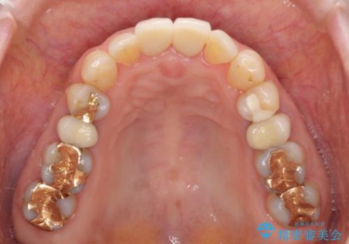歯茎の腫れた前歯を綺麗にしたい　部分矯正を用いたセラミック治療の治療後