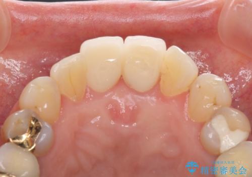 歯茎の腫れた前歯を綺麗にしたい　部分矯正を用いたセラミック治療の治療後