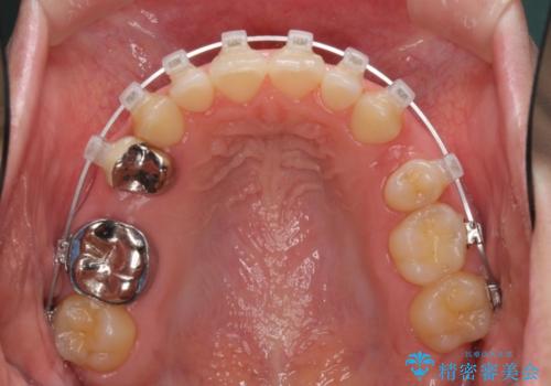 上の前歯の出っ歯を抜歯矯正で改善の治療中