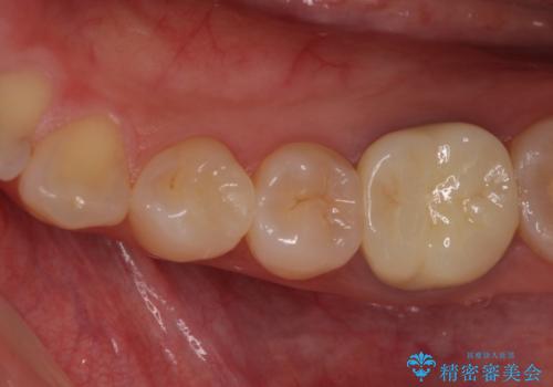 セラミックインレーによる早期発見の虫歯治療の治療後