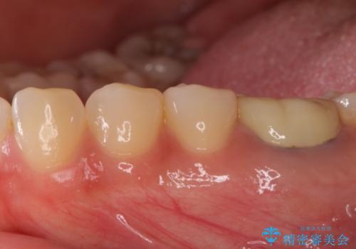 セラミックインレーによる早期発見の虫歯治療の治療後