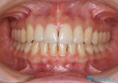 前歯のでこぼこを改善　インビザラインによる矯正治療の治療後
