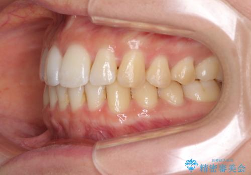 前歯のでこぼこを改善　インビザラインによる矯正治療の治療後