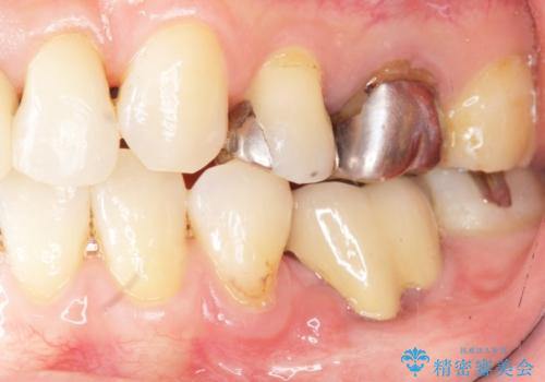 不適合なつめ物による歯ぐきの違和感　40代女性の症例 治療後
