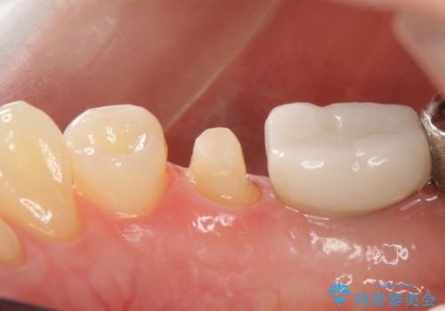 オールセラミッククラウン　歯茎との隙間が気になる被せ物の修復の治療中