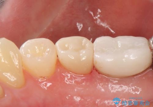 オールセラミッククラウン　歯茎との隙間が気になる被せ物の修復の治療後