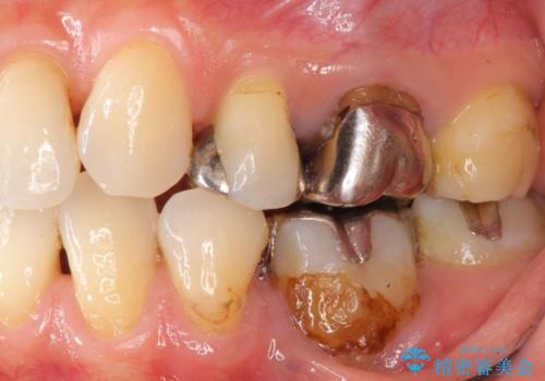 不適合なつめ物による歯ぐきの違和感　40代女性の治療前