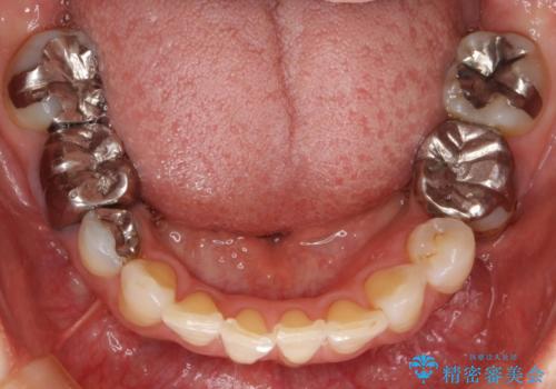 不適合なつめ物による歯ぐきの違和感　40代女性の治療前
