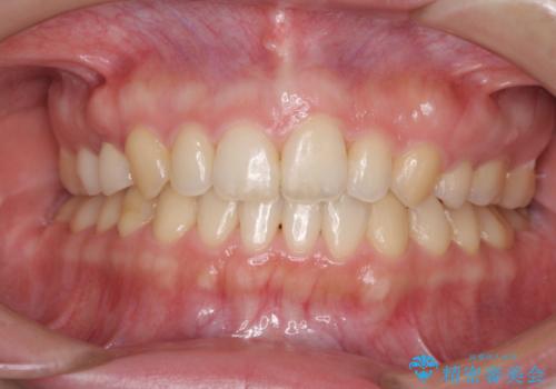 上の前歯の出っ歯を抜歯矯正で改善の症例 治療後