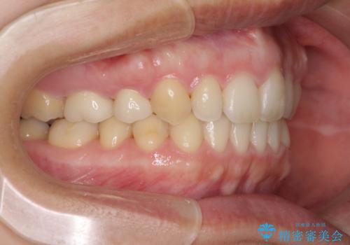 上の前歯の出っ歯を抜歯矯正で改善の治療後