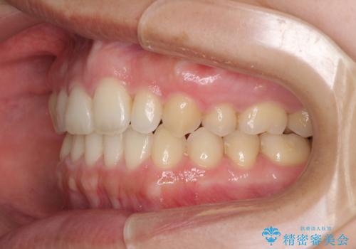 上の前歯の出っ歯を抜歯矯正で改善の治療後