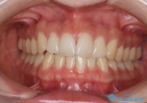 前歯のでこぼこを改善　インビザラインによる矯正治療の治療前