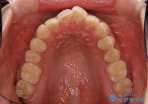前歯のでこぼこを改善　インビザラインによる矯正治療の治療前